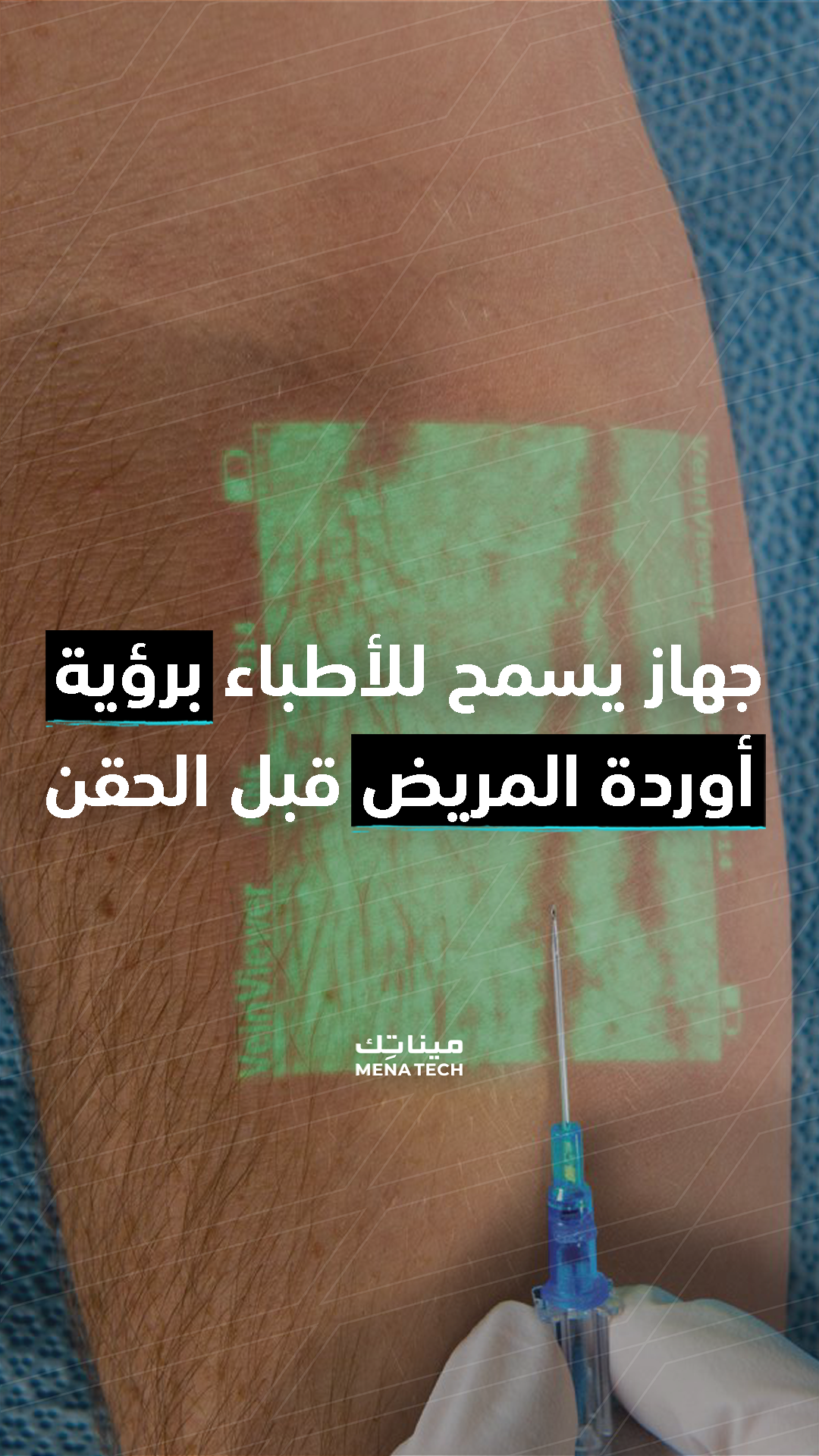 تقنية تساعد الأطباء على إظهار أوردة المرضى بوضوح