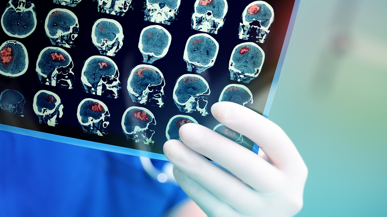 متفوقاً على الأطباء، الذكاء الاصطناعي يحقق دقة شبه كاملة في تشخيص السرطان